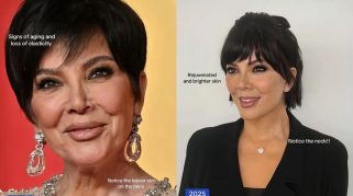 Kris Jenner operasi plastik